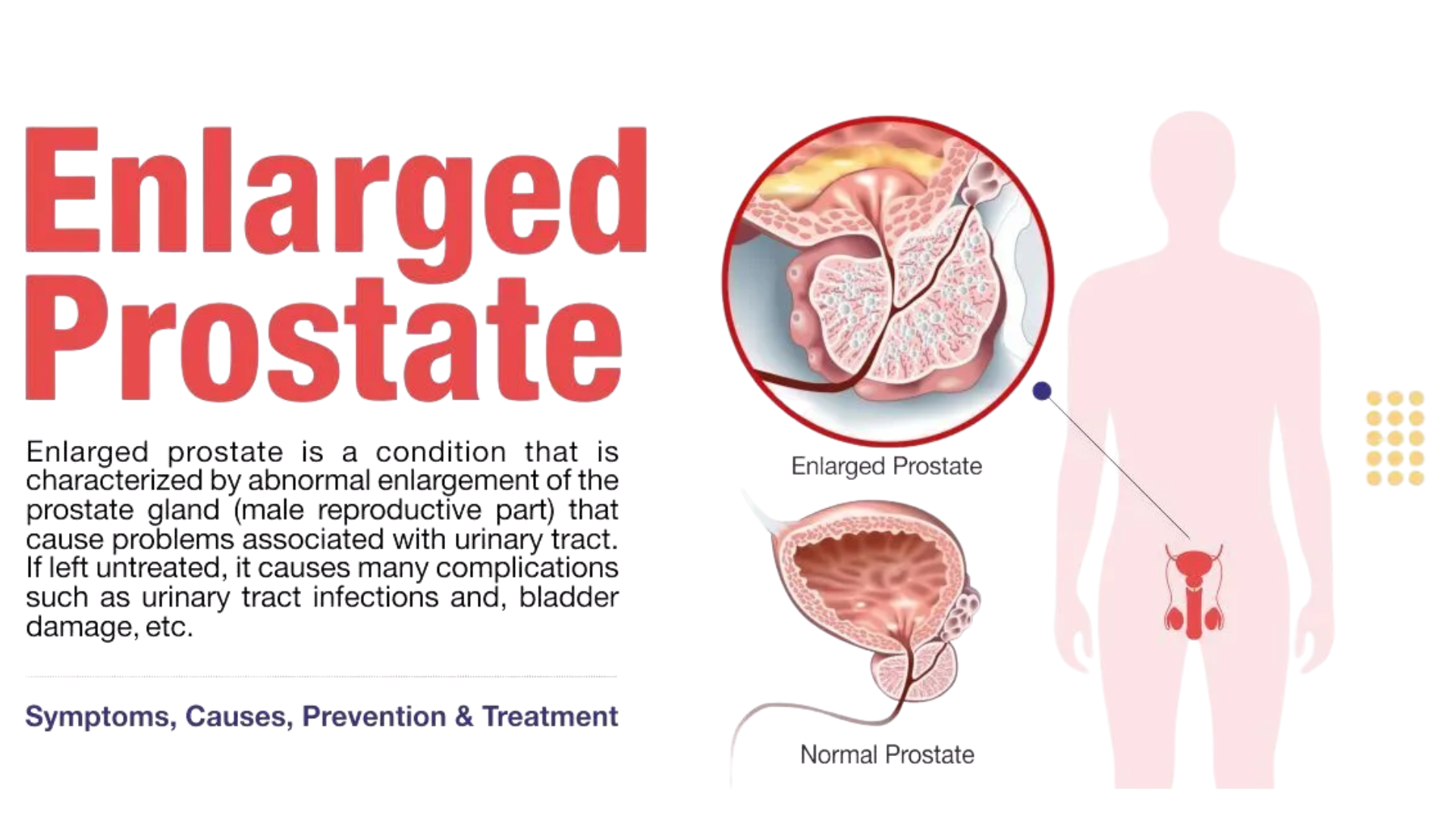 Stop Prostate Swelling