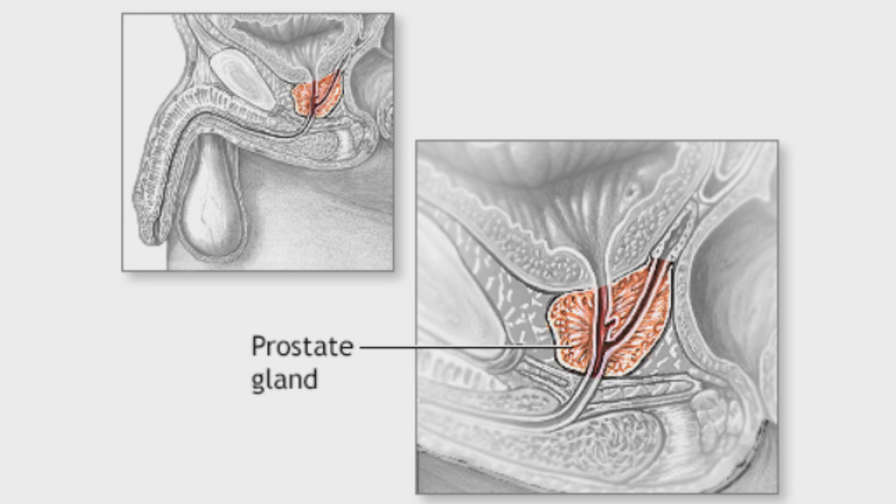 Prostate Enlargement Causes